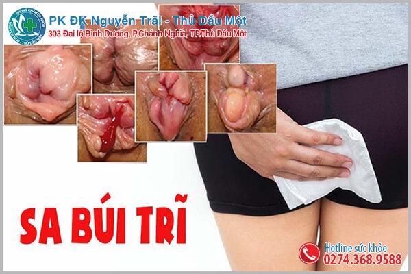 Triệu chứng sa búi trĩ gây nhiều phiền toái cho người bệnh